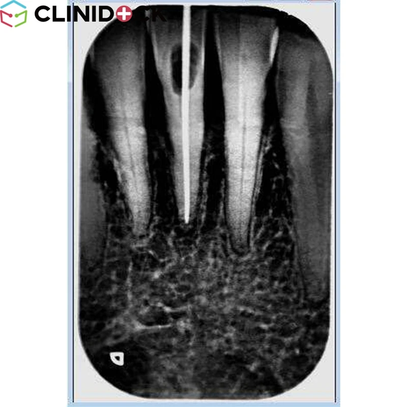 New Style Hot Selling Dental X-ray Unit CDX1006 Portable Mobile Dental Sensor Single Tooth X-ray Machine