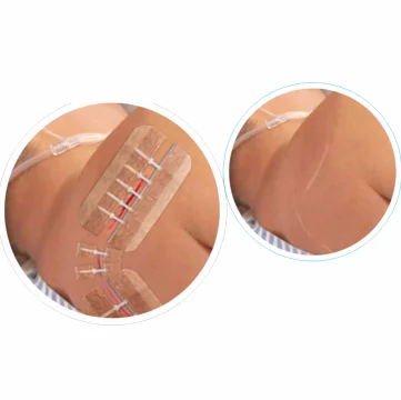 Chinese Factory Direct Wholesale High Pulling Force 1.5 CM Wound Closure Strips  Alternatives For Wound Sutures