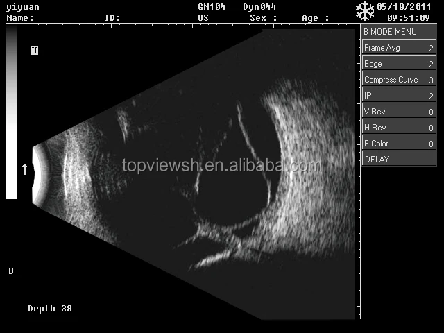 Optical instruments ultrasonic scanner ODU 5 for eye hospital