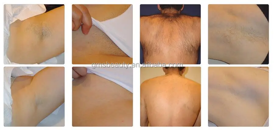 3000W Permanent Laser Depilacion 808nm Diode Laser Hair Removal Equipment