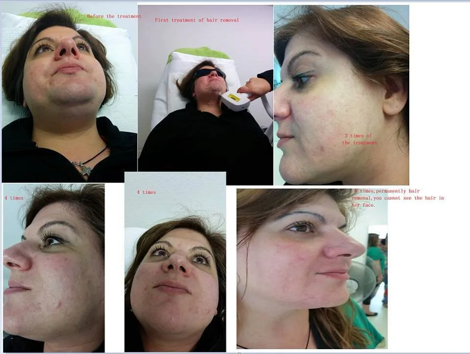 3 Waves in 1 755nm 808nm 1064n 808nm Diode Laser Hair Removal Machine