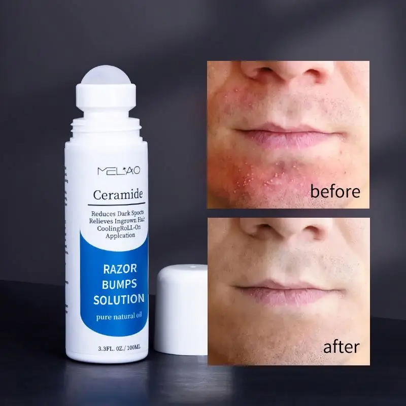 oem Roll On Solution Razor Bump Treatment After Shave Serum For Men And Women