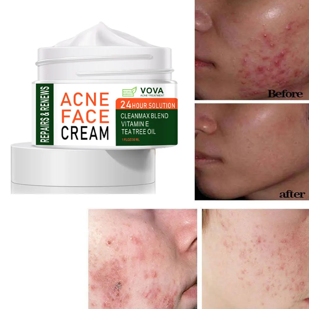VOVA Acne Removal Cream Herbal Acne Spots Oil Control Acne Cream Skin Care Whitening Moisturizing Face Gel Skin Care