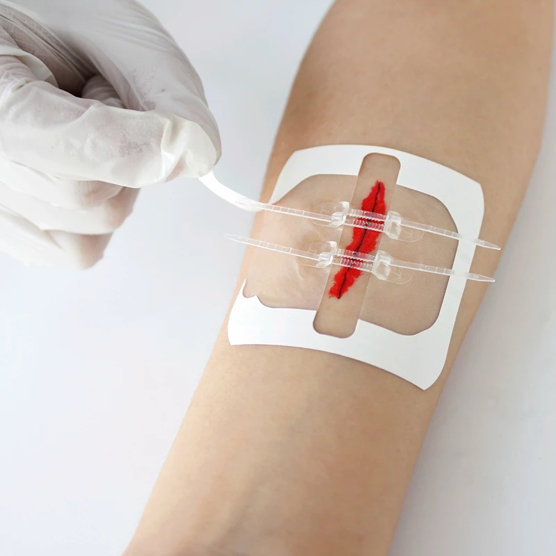 
Skin closure wound plaster dermabond supplier wound closure zipper 