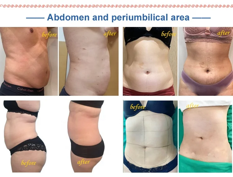 Portable Lipolysis Laser Aesthetic Plastic Laser For Lipolysis And Skin Tightening