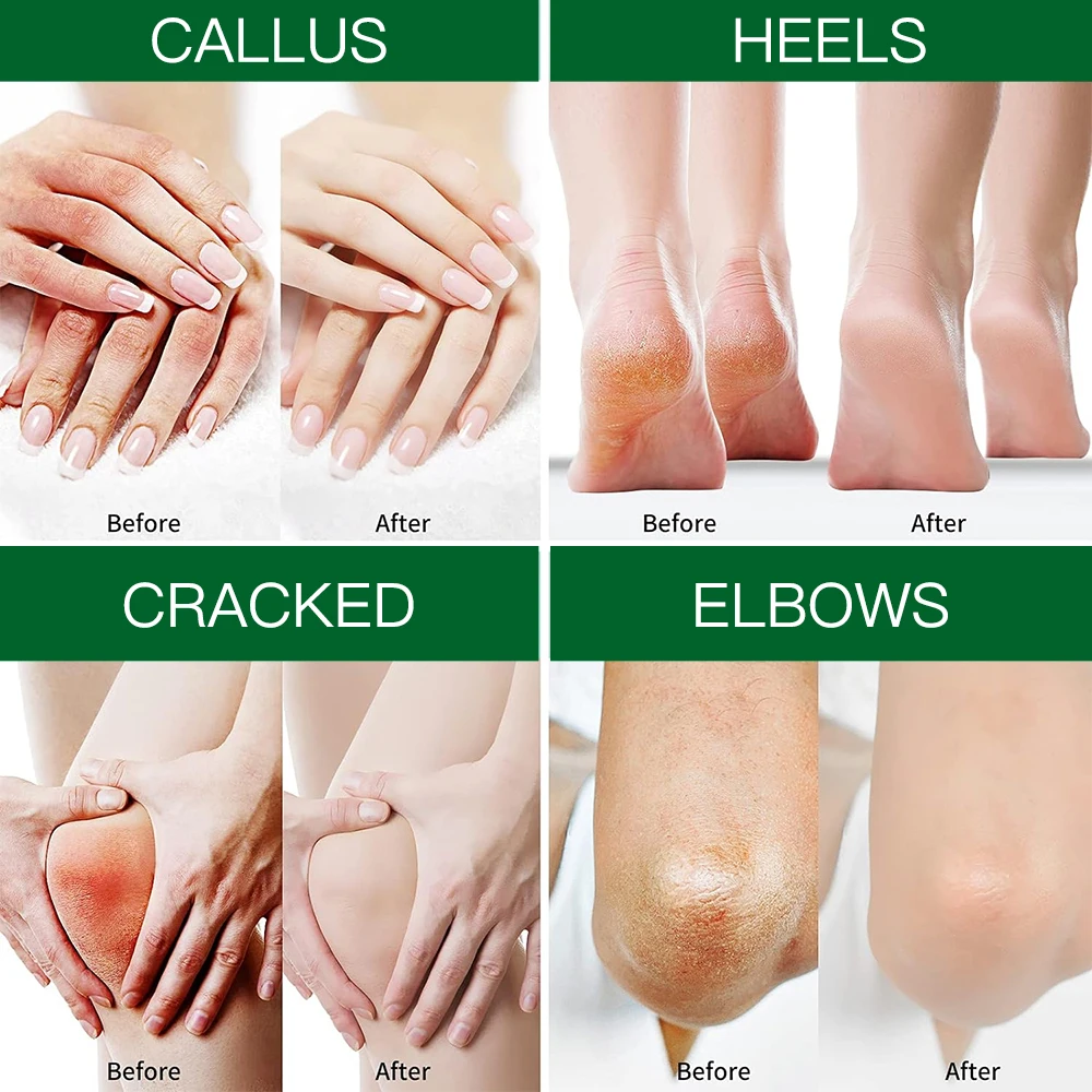 Лучший отбеливающий крем для рук и ног масло ши восстановления мочевины 40 массажный увлажняющий Крем чайное дерево против трещин