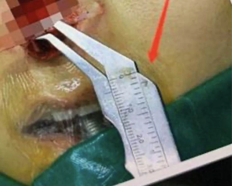Rhinoplastic Nasal Surgical Instruments Korea Type Vernier Caliper for Face with Beak Type and Eagle Nose Type