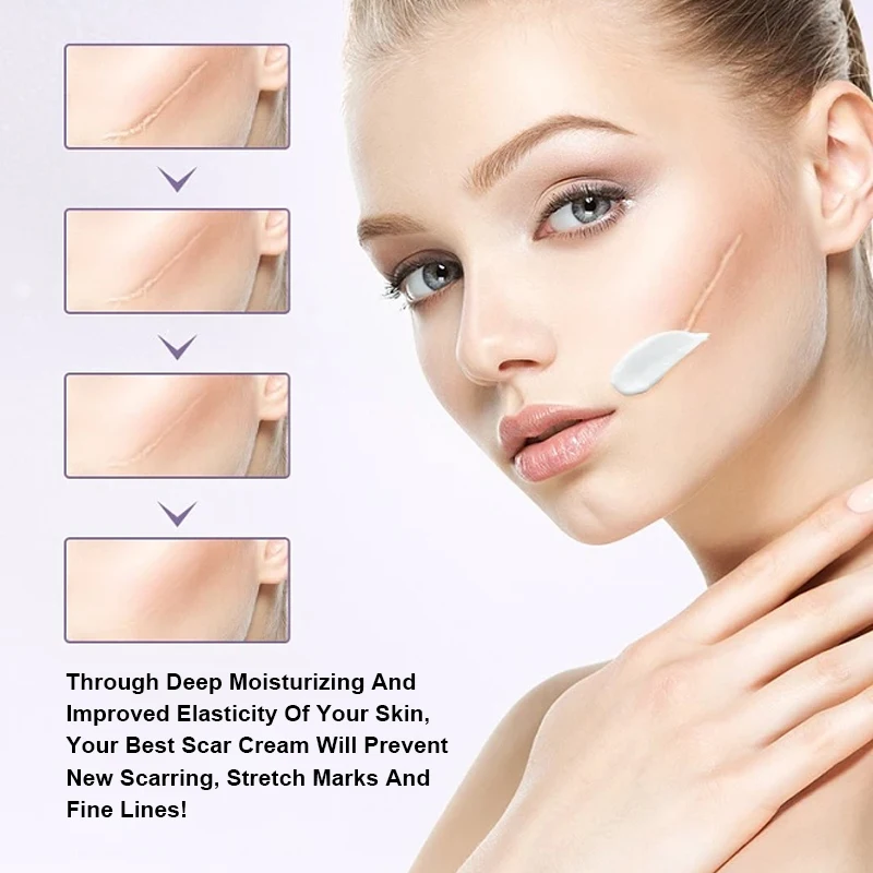 Oem/Odm Brand Dark Spot Repairing Acne Stretch Marks And Scar Removal Cream For Old Scars On Face