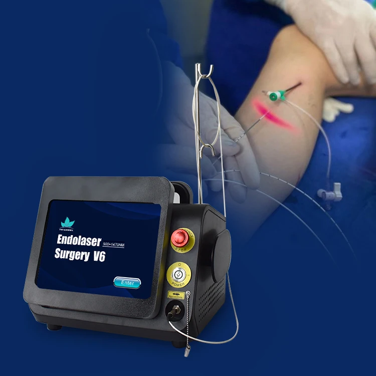 Triangel Professional Varicose Veins Removal Treatment Radial 360 degrees Optical Fibers Diode Laser