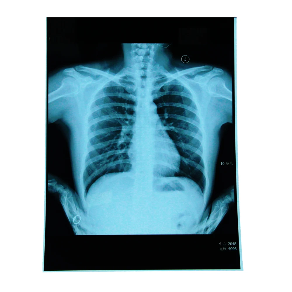 Plastic surgical thermal film medical thermal roll transparent film