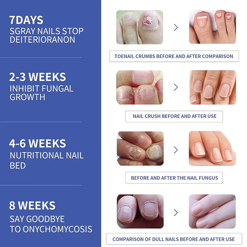 Restores Healthy Appearance Nighttime Renewal Fungal  Overnight Nail Treatment Patches for Nail Fungus Damage