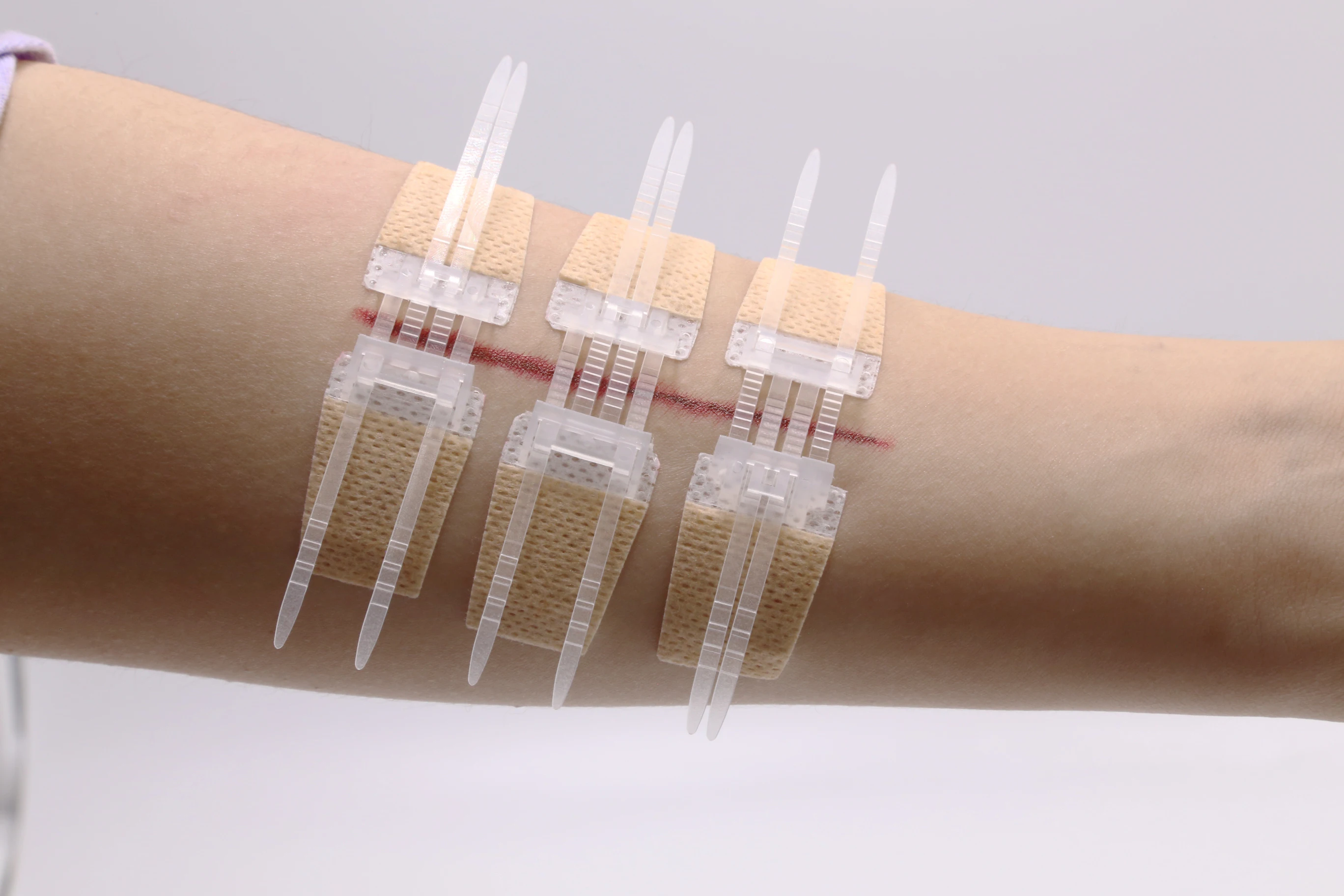 medical wound closure device non-invasive suture skin surface stapler zip stitch