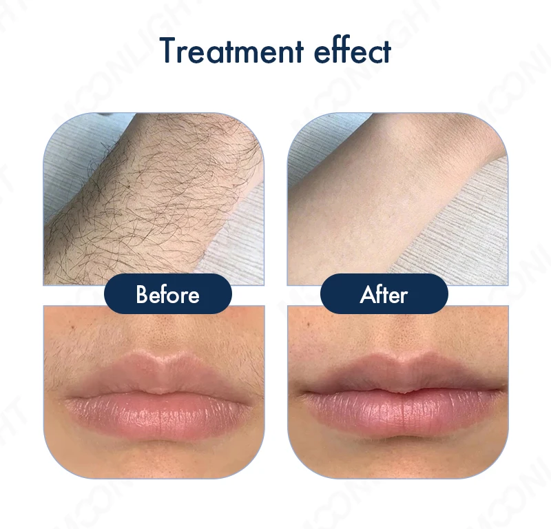 808 diode carbon long pulse nd yag laser 1064 gel and pico 2in1