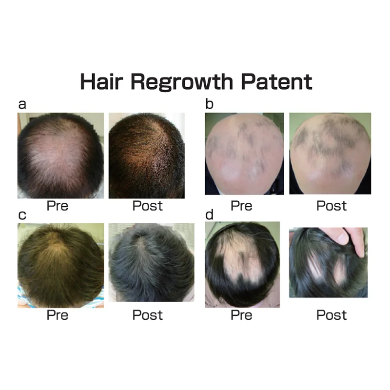 Preventing osteoporosis King Agaricus vitamins hair growth supplement