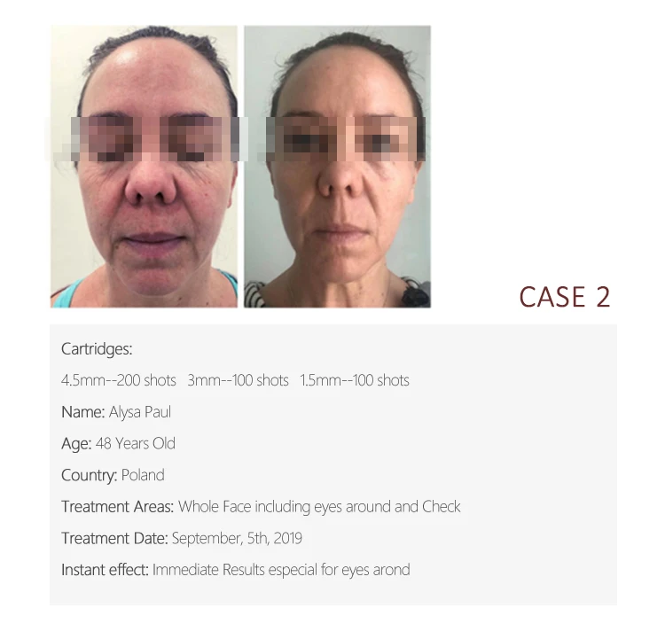 Dual Handle 2 in 1 Painless 11 Line 4D 5D Hifu Cartridge 100 000 Shots Smas Treatment Machine Facial