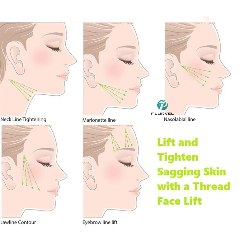 Korean Absorbable Face Lifting PDO Cog Molding Collagen Threads  Mono Barbed V Line Wrikles Lift