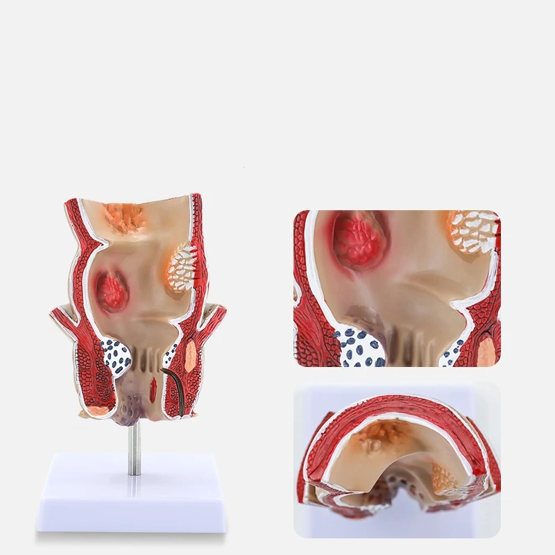 rectal hemorrhoids colorectal disease model Internal and external rectal hemorrhoids anorectal model