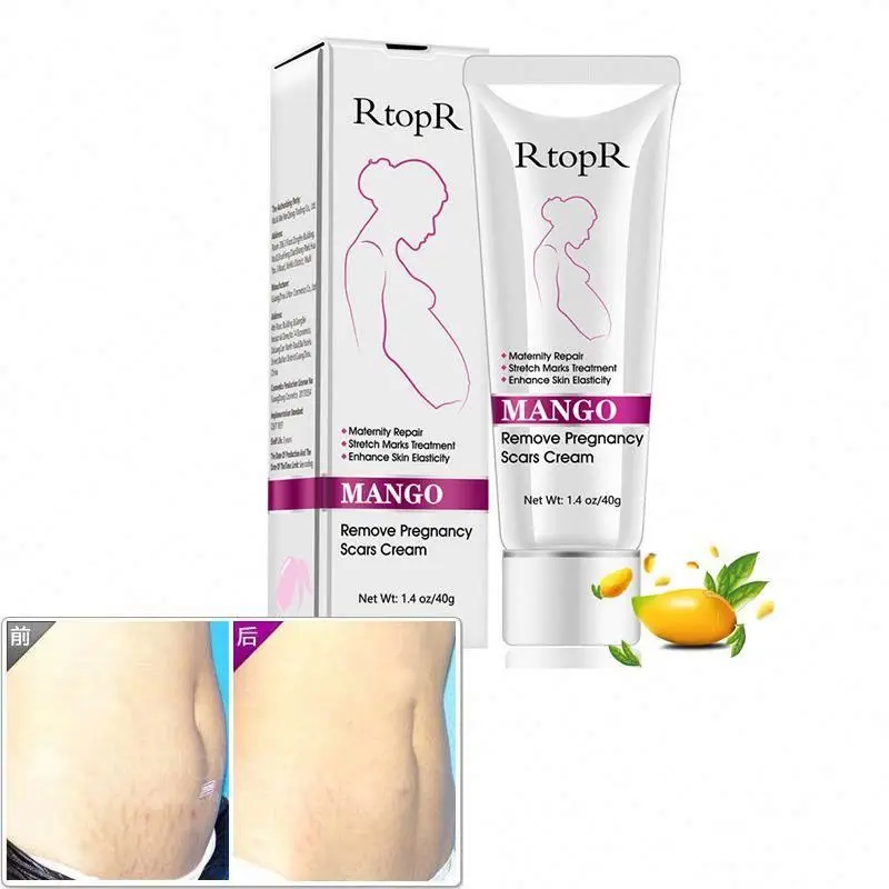 Stretch marks removal cream