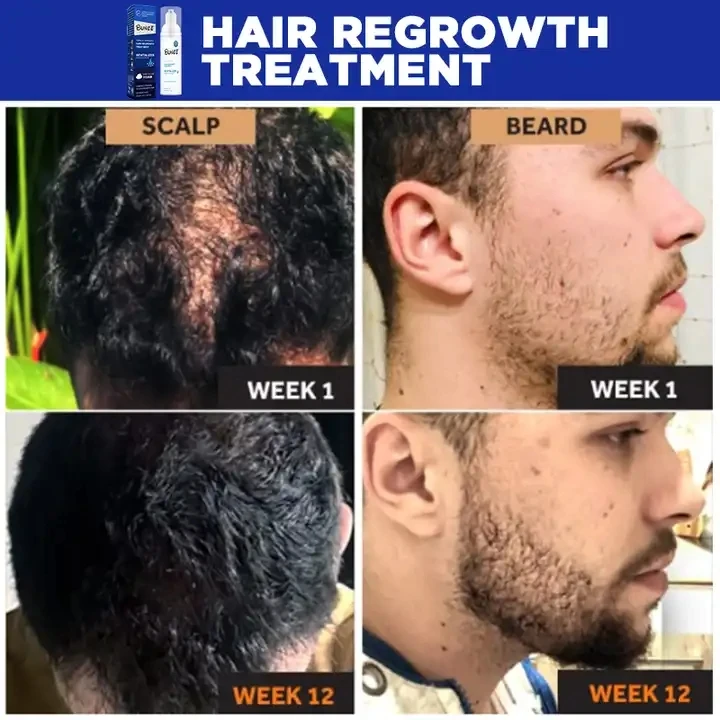60ml private label Topical solution Collagen biotin bald hair growth oil foam