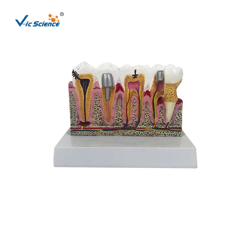 diseased teeth and gums anatomy model big size teeth dental teaching model