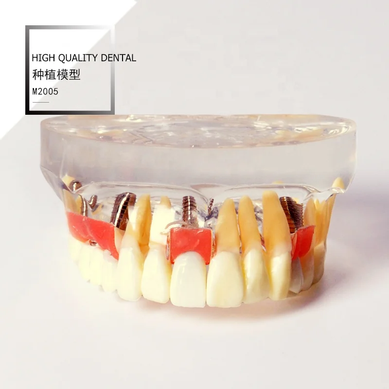 Демонстрационная модель имплантации с одной короной и мостом