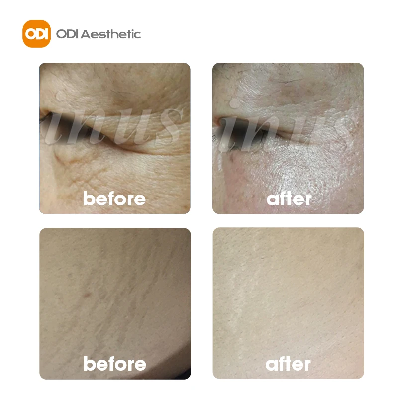 Rf Microneedling Machine Inus Microneedling Eyelids Face & Neck Lifting Stretch Marks Removal Korea Rf Microneedling Machine