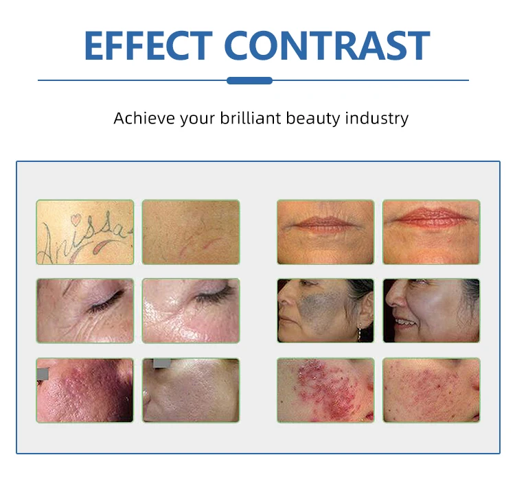 Pico laser machine 532nm 1064nm 1320nm tattoo removal acne treatment medical equipment