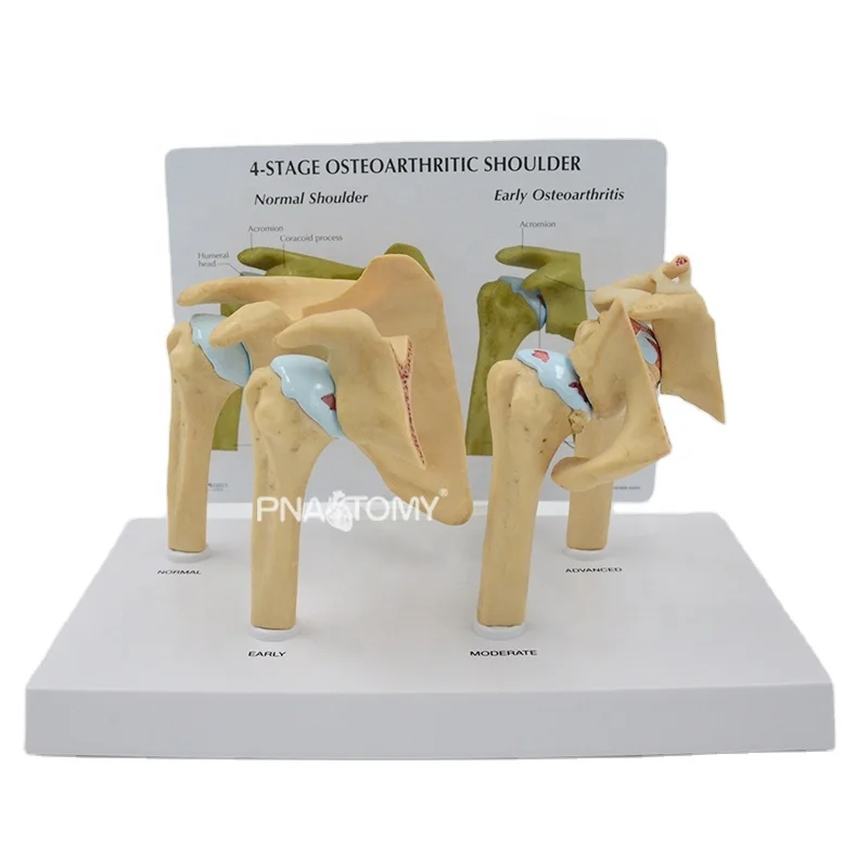 4-STAGE OSTEOARTHRITIS (OA) SHOULDER ANATOMY MODEL HUMAN SKELETON ANATOMICAL MODEL TEACHING RESOURCES EDUCATIONAL EQUIPMENT