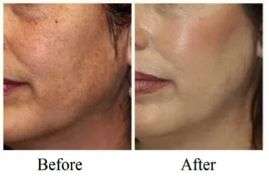 
Otesaly Skin Lightening Mesotherapy Ampoules For Skin Injection With 5ml*10vials 