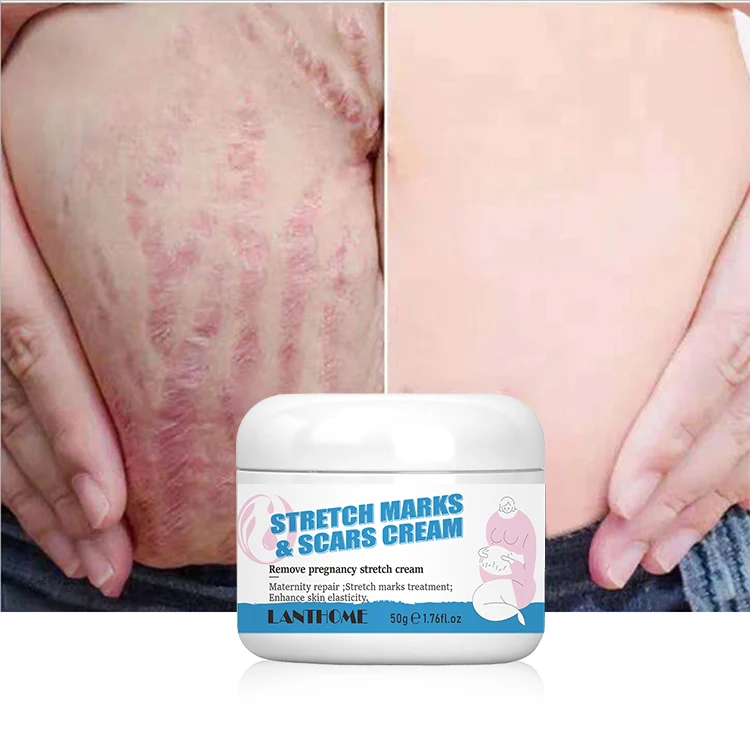 Make Your Own Body Skin Care Skin Repair Remove Clear Pregnancy Scar Removal Stretch Mark Cream