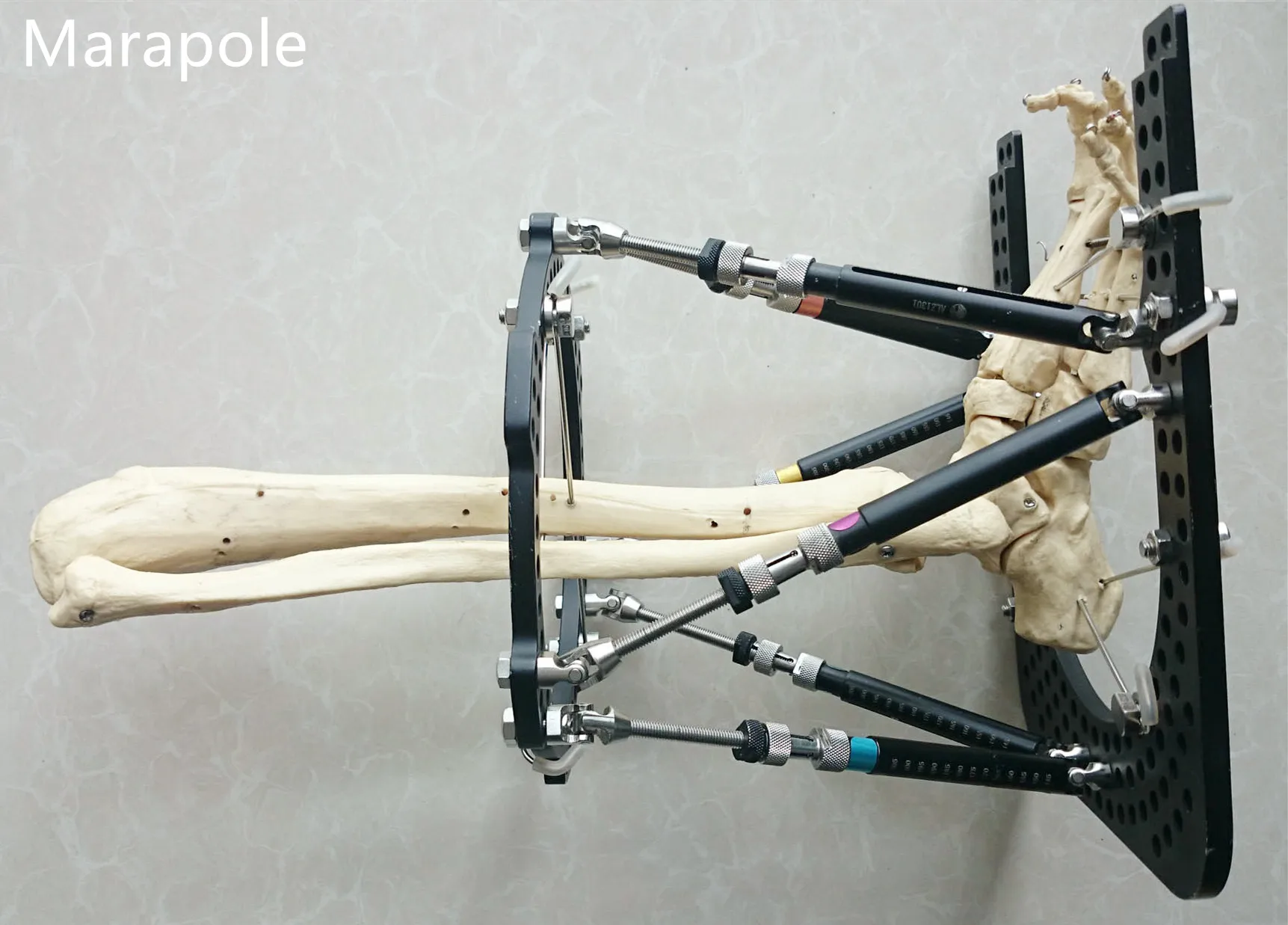 Ilizarov external fixator with foot ring