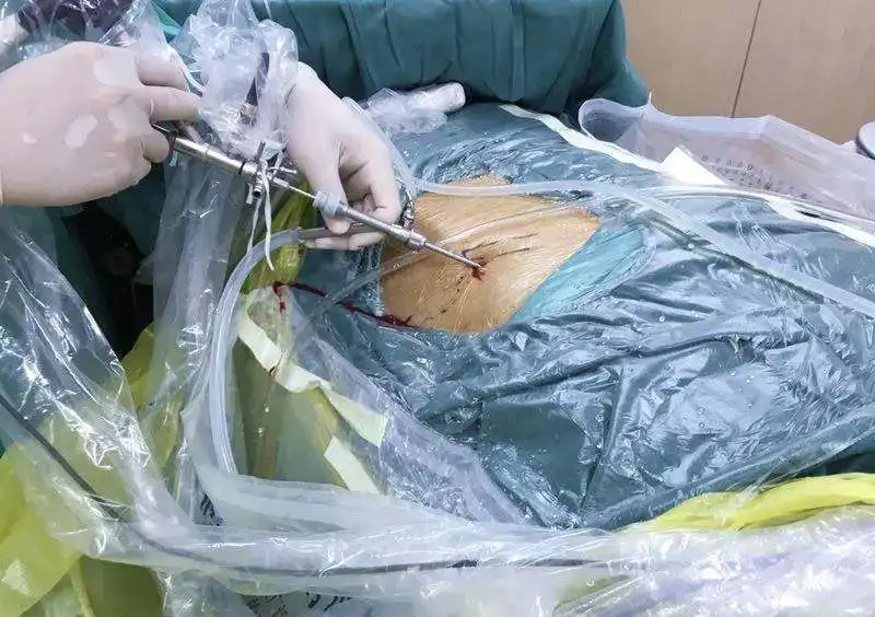 JS-1W (19Fr)Transcutaneous Nephroscope Surgical instruments Urology