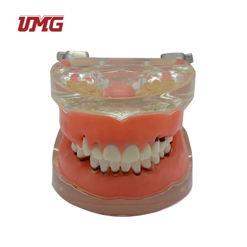 Pathology Periodontal Gingiva Disease Model for Education Teaching
