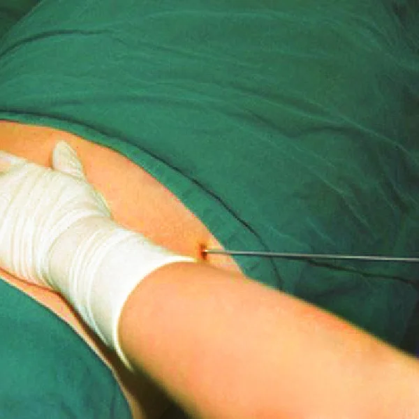 Laserconn slimming 980nm vaser liposuction machine 1470nm laser lipolysis fat removal lipo laser machine