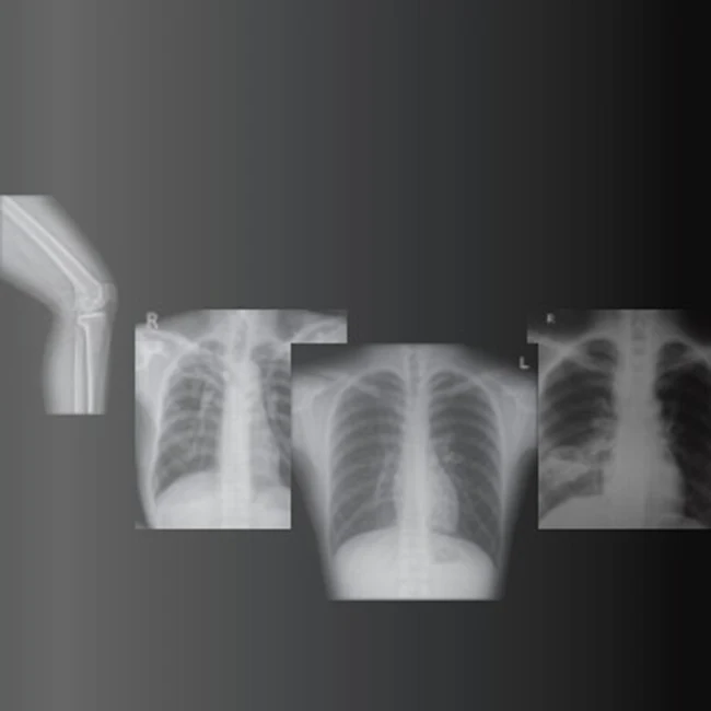 
Hot Sale Medical Imaging Equipment Portable X-Ray Machine Price Radiography System for Hospital 