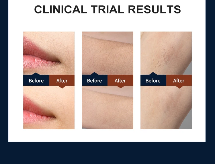 2022 Mismon Home Use Sapphire Electrolysis IPL Hair Removal 999999