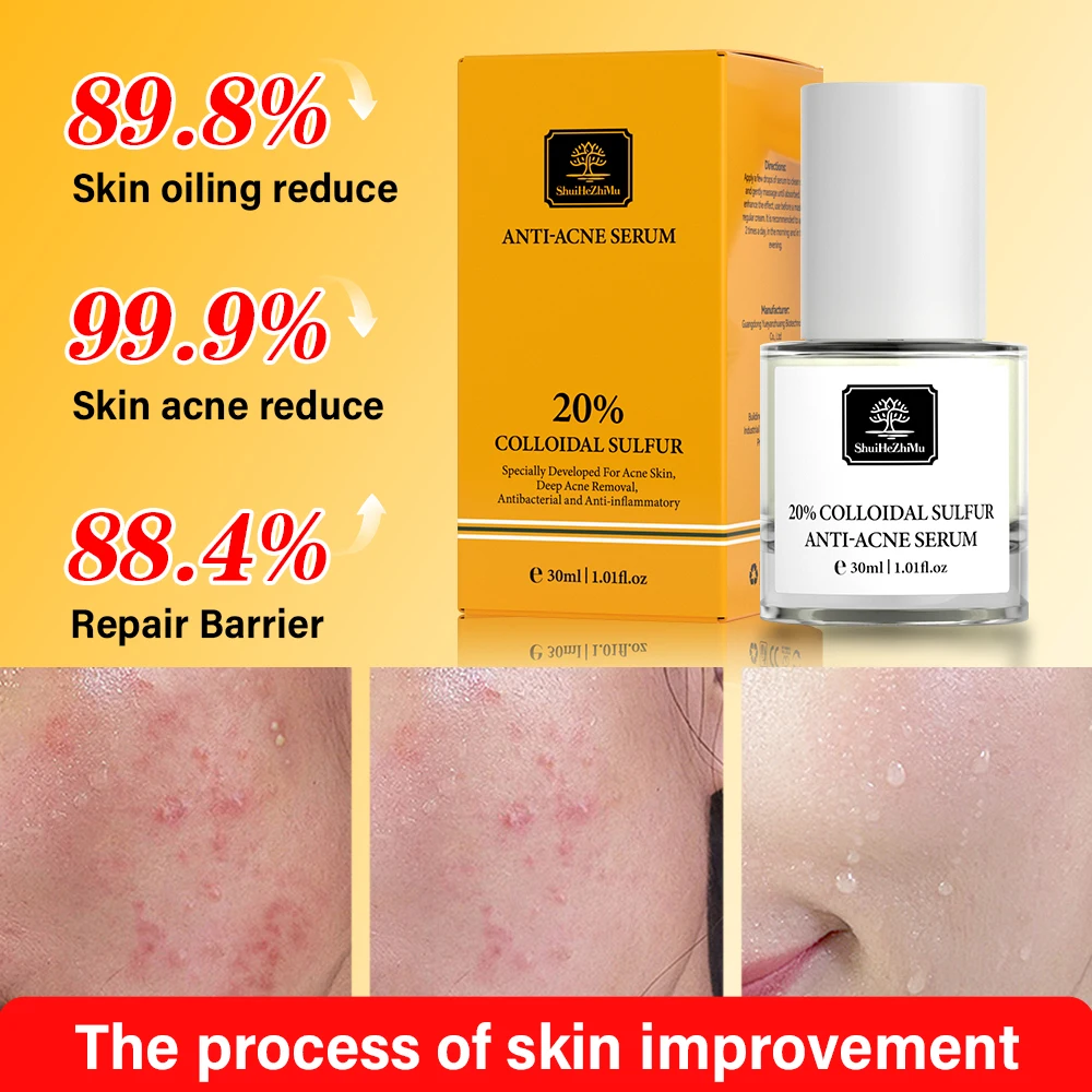 Colloidal Sulfur Anti-acne Serum For Acne Treatment Balancing Water Oil Improving Acne Scars Face Serum