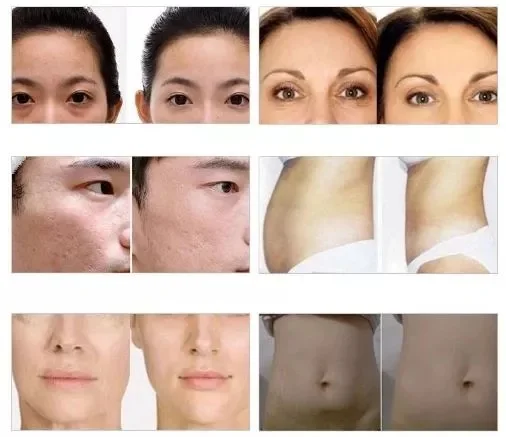 handheld c2p cdt carboxy needle therapy injector beauty device