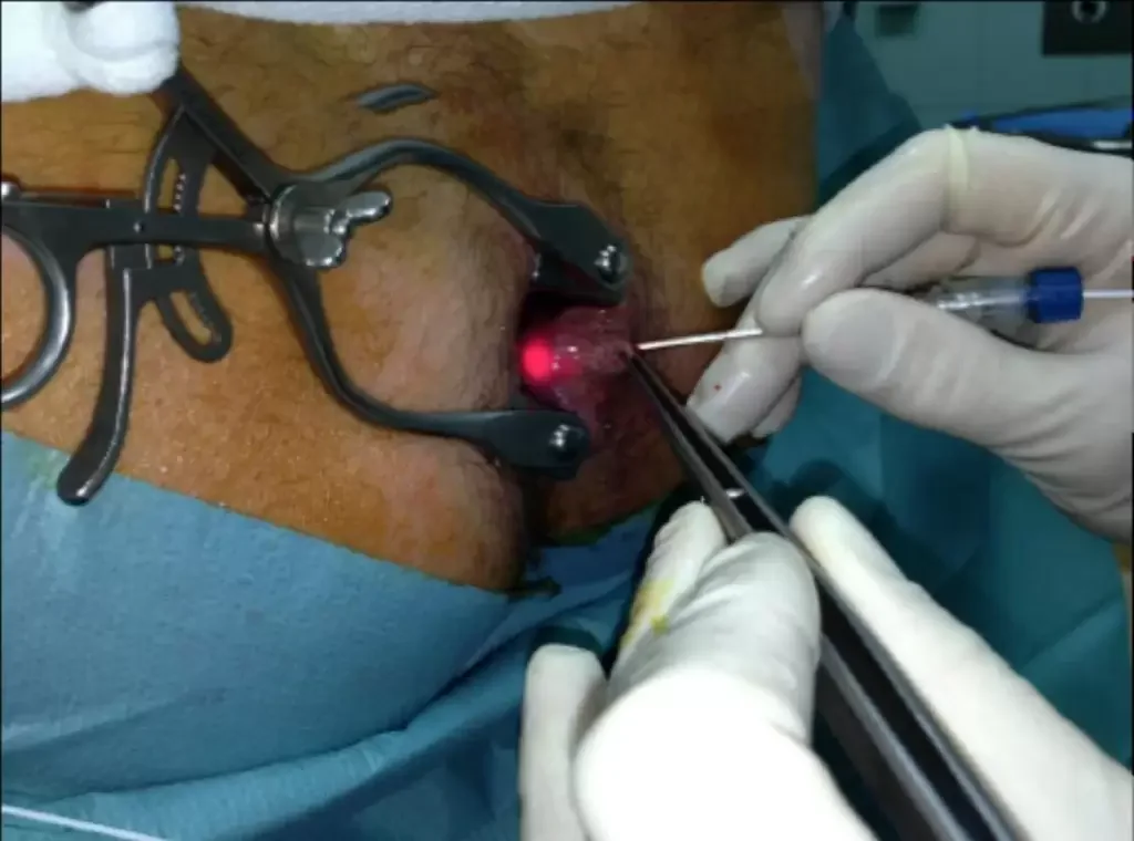 15W 30W 60W 17W Medical standard USE 980NM 1470NM endolaser diode laser for surgery vascular Removal veins removal liposuction