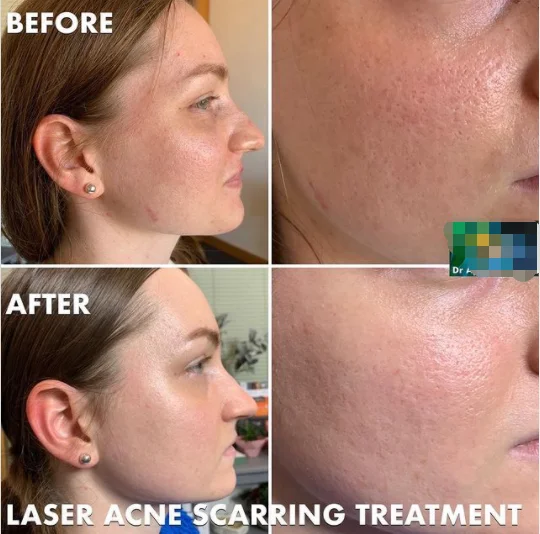 Stationary CO2 Fractional Laser Machine for Vaginal Skin Tightening and Scar Removal Laser Beauty Equipment