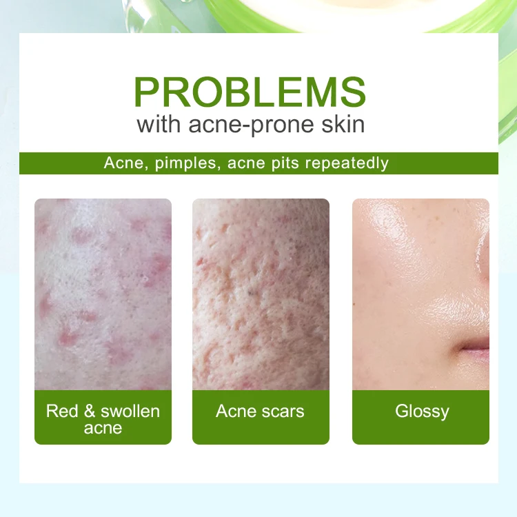 AILKE Acne Treatment Cream Anti Acne Face Cream & lotion Spots Oil Control Shrink Pores Moisturizing Skin Care Serum 50g*2