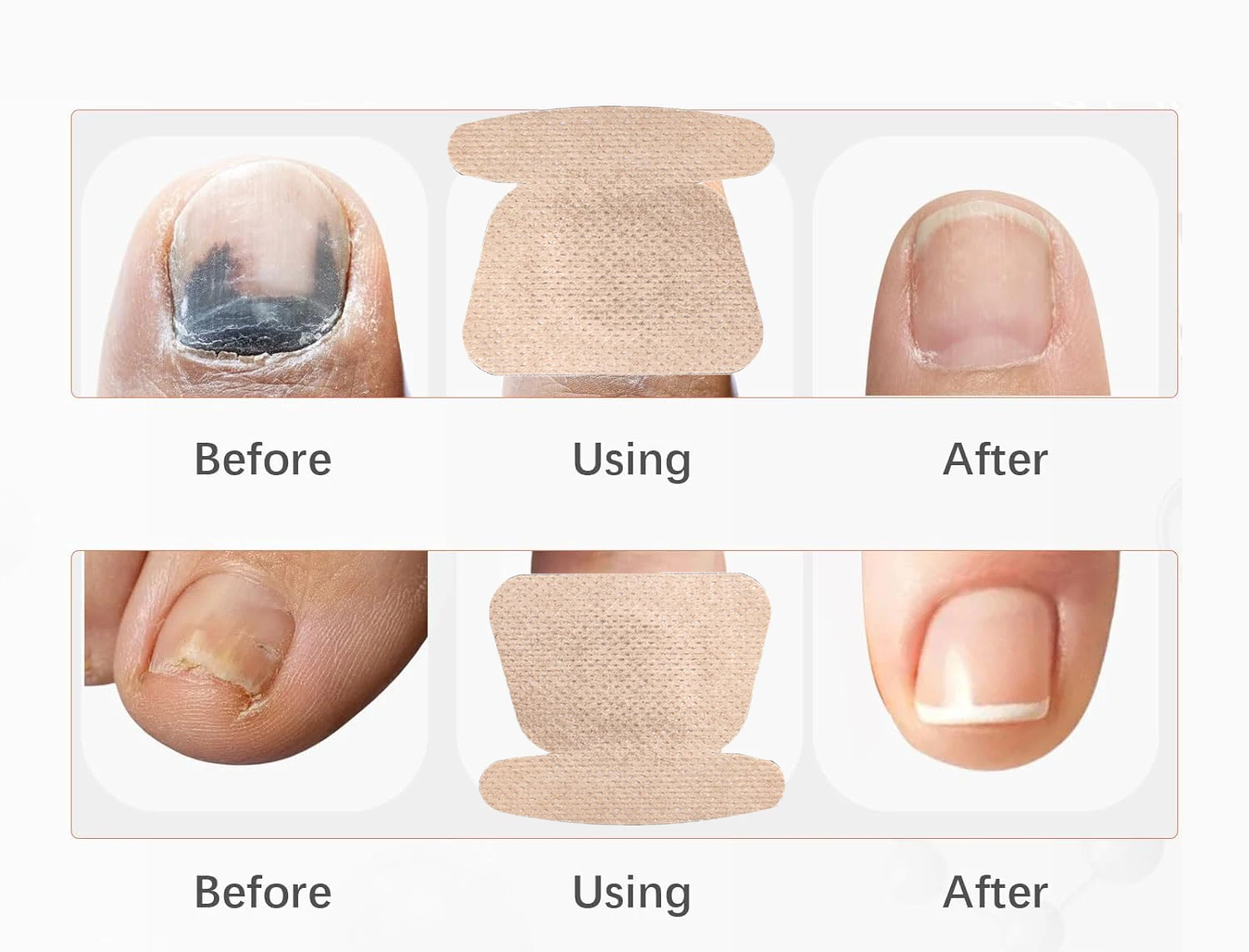Multi Purpose Nail Repair Patches Toenail Treatment Anti Fungal Nail Correction Stickers Private Label Nail Repair Patch