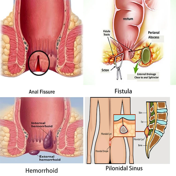 Fistula laser.jpg