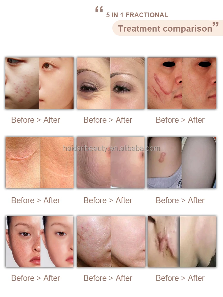 fotona pro laser (4).jpg