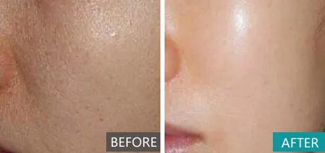 
Otesaly Skin Lightening Mesotherapy Ampoules For Skin Injection With 5ml*10vials 