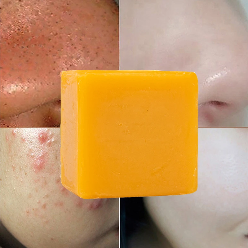 Private label Natural Organic Handmade Anti-Acne Removing Dark Spots Herbal Turmeric Soap
