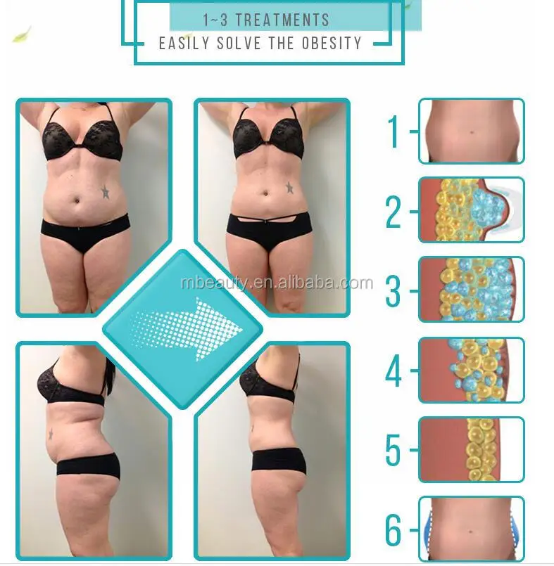 New Product Cellulite Removal Fat Freeze Equipment Cryotherapy