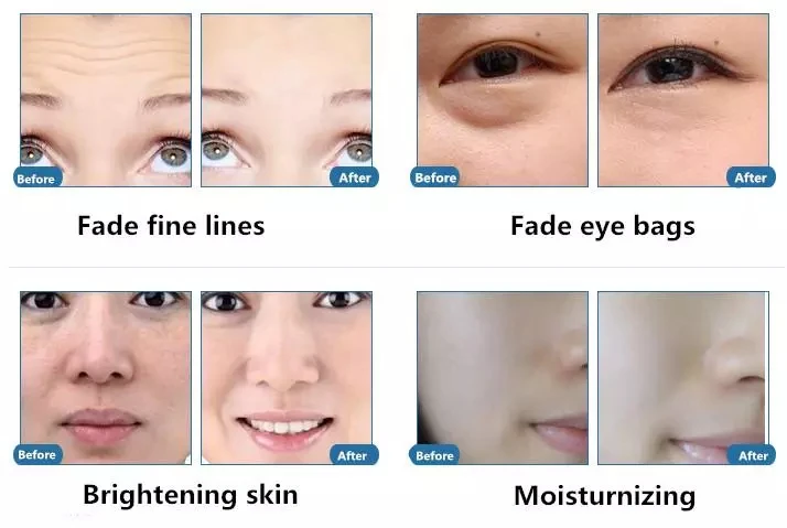 Injection Mesotherapy Facial EMS No Needle Free Needless Skin Rejuvenation ems rf nano needles mesotherapy beauty mesogun