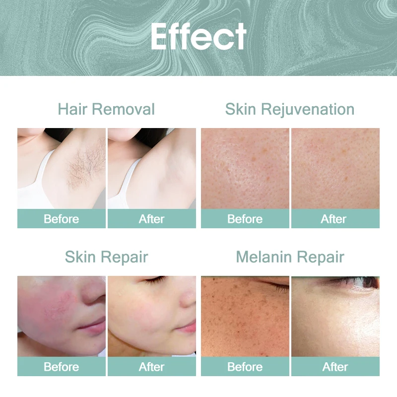 Hot Sale 808nm Diode Laser Hair Removal Machine Esthetician 755 808 940 1064nm Diode Laser Person Care Painless Body Care