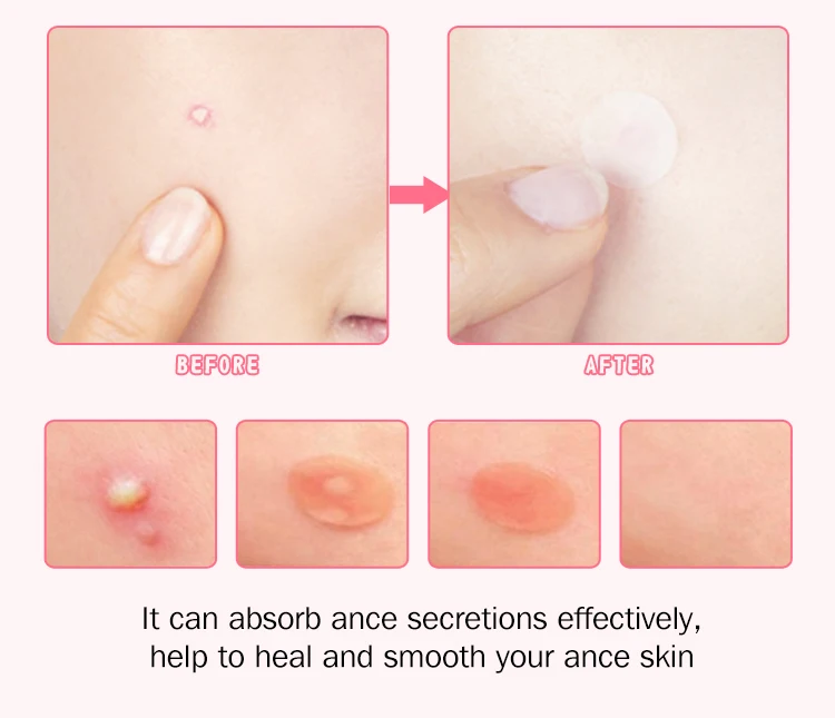 The top selling acne treatment patch from Korea